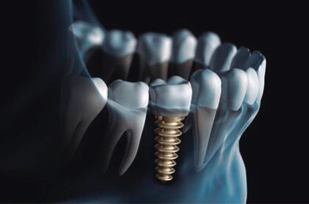 implante dental en alaquas